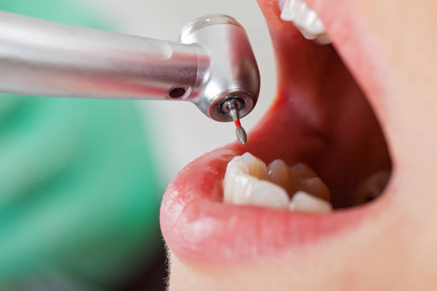 Best Emergency Dental Surgery in Palm City, FL